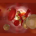 3D animation of clogged and tightened rtery with cholesterol cells