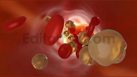 3D animation of clogged and tightened rtery with cholesterol cells