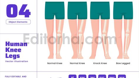 Human Legs Deformity Syndrome - Biology Anatomy