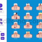 Decay Tooth - Dentist Dental Human Tooth Anatomy