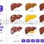 Liver Disease - Internal Human Body Organ Cancer