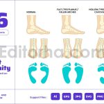 Foot Deformities - Abnormal Feet Misalignment