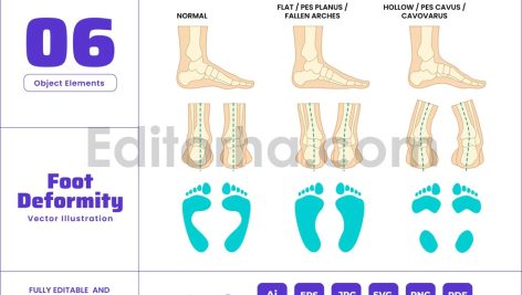 Foot Deformities - Abnormal Feet Misalignment