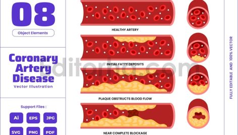 Coronary Artery Disease Types - Heart Blockage