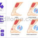 Achilles Tendon Pain Foot and Ankle Muscle Injury