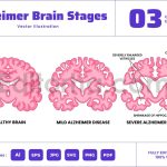 Alzheimer's Disease Brain Stages Cross Section
