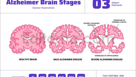 Alzheimer's Disease Brain Stages Cross Section