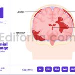 Intracranial Hemorrhage - Brain Bleeding Injury