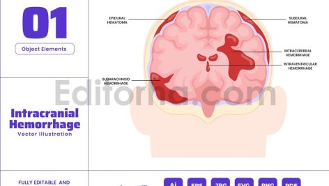 Intracranial Hemorrhage - Brain Bleeding Injury