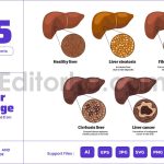 Fatty Liver Disease Stages - Damage Care Treatment