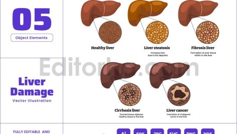 Fatty Liver Disease Stages - Damage Care Treatment