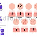 Types of Acne Care - Healthy Skin Dermatology