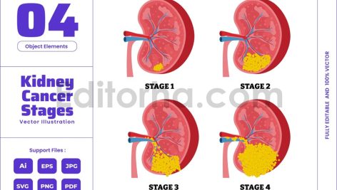 Kidney Cancer Stages Human Internal Organ Disease