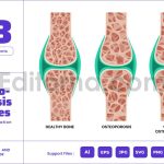 Osteoporosis Stages with Bone Skeletal System