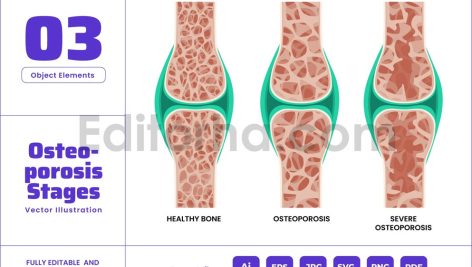 Osteoporosis Stages with Bone Skeletal System