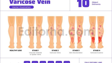 Varicose Vein Stages - Spider Vein Leg Disorder
